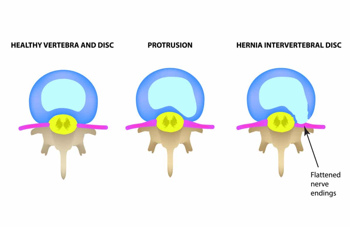 diagram of disc protrusion and hernia