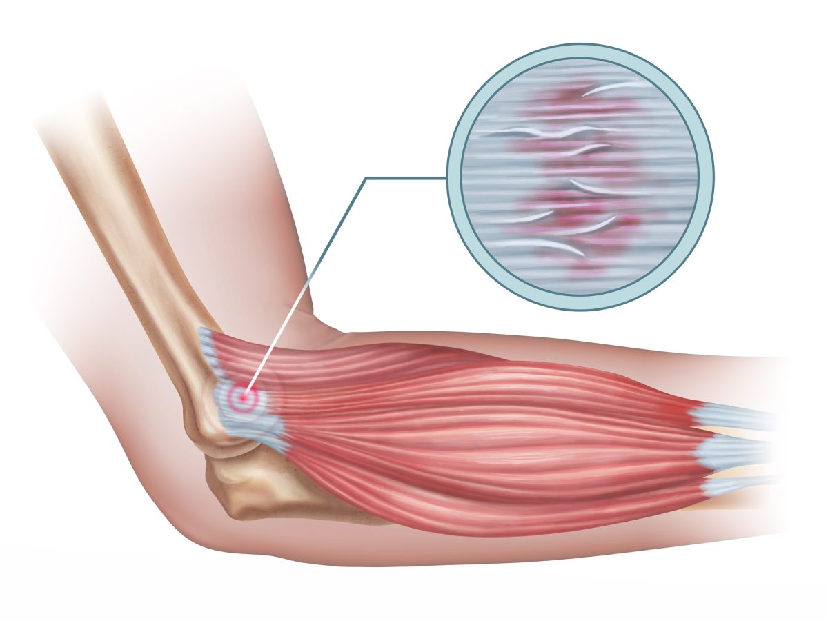 illustrated diagram of tennis elbow