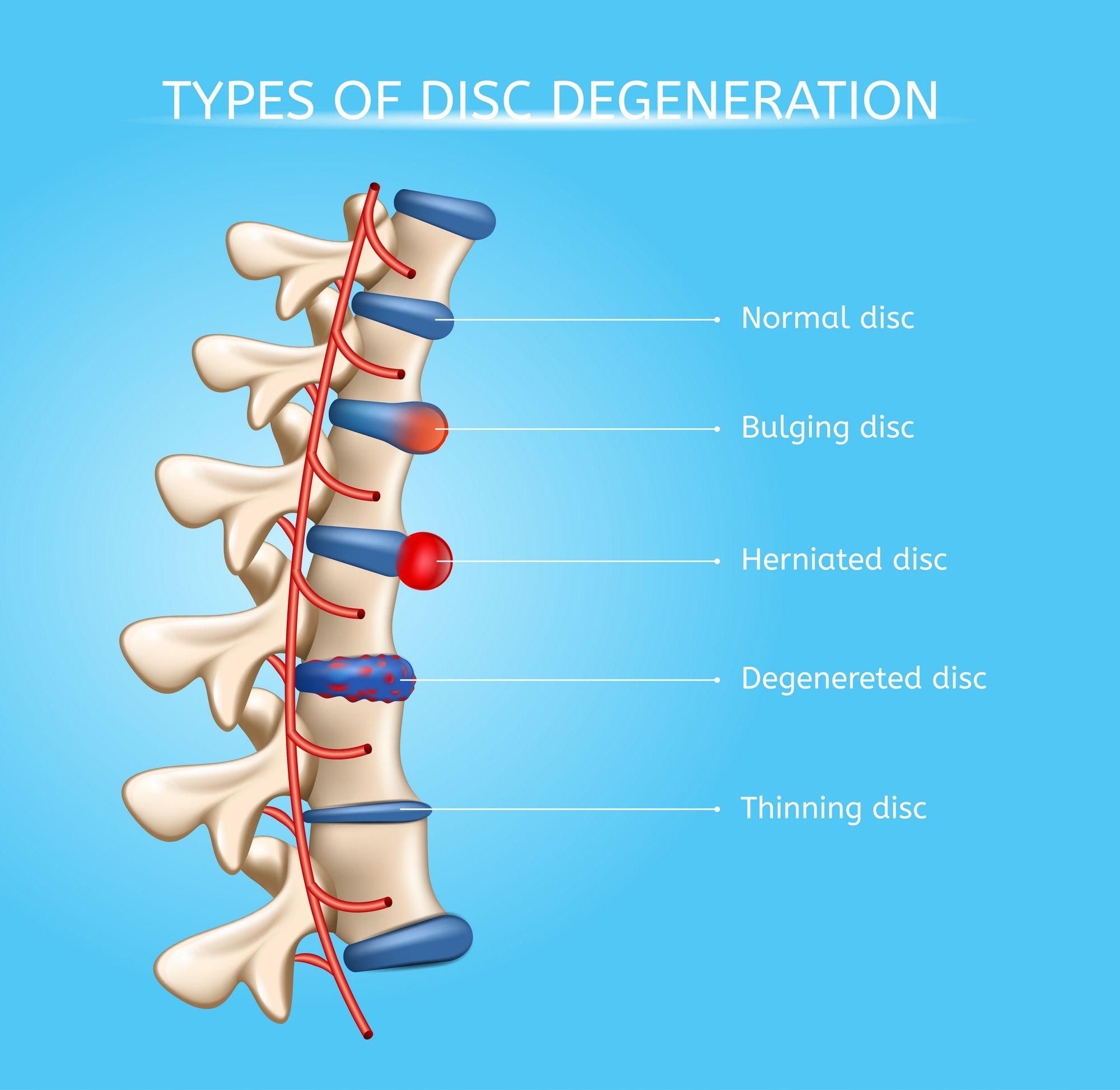 visual chart showing the types of disc degeneration