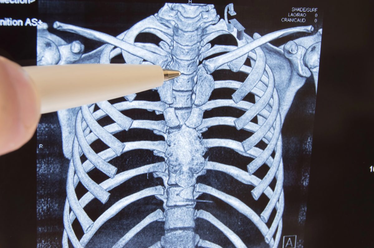 pen pointing to a scan of the upper spine in a patient with upper back pain
